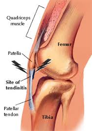 Site of Tendonitis