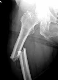 Concerns raised over long-term use of bone drugs